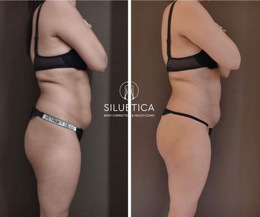 Back and flanks — Before / After